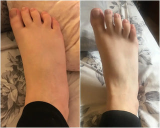 Neuropathy Before After